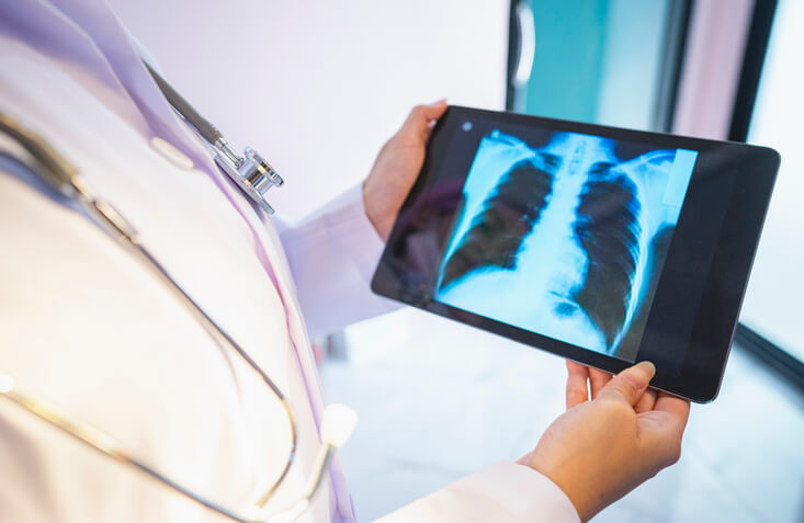 Avanzando en un método de detección precoz del cáncer de pulmón