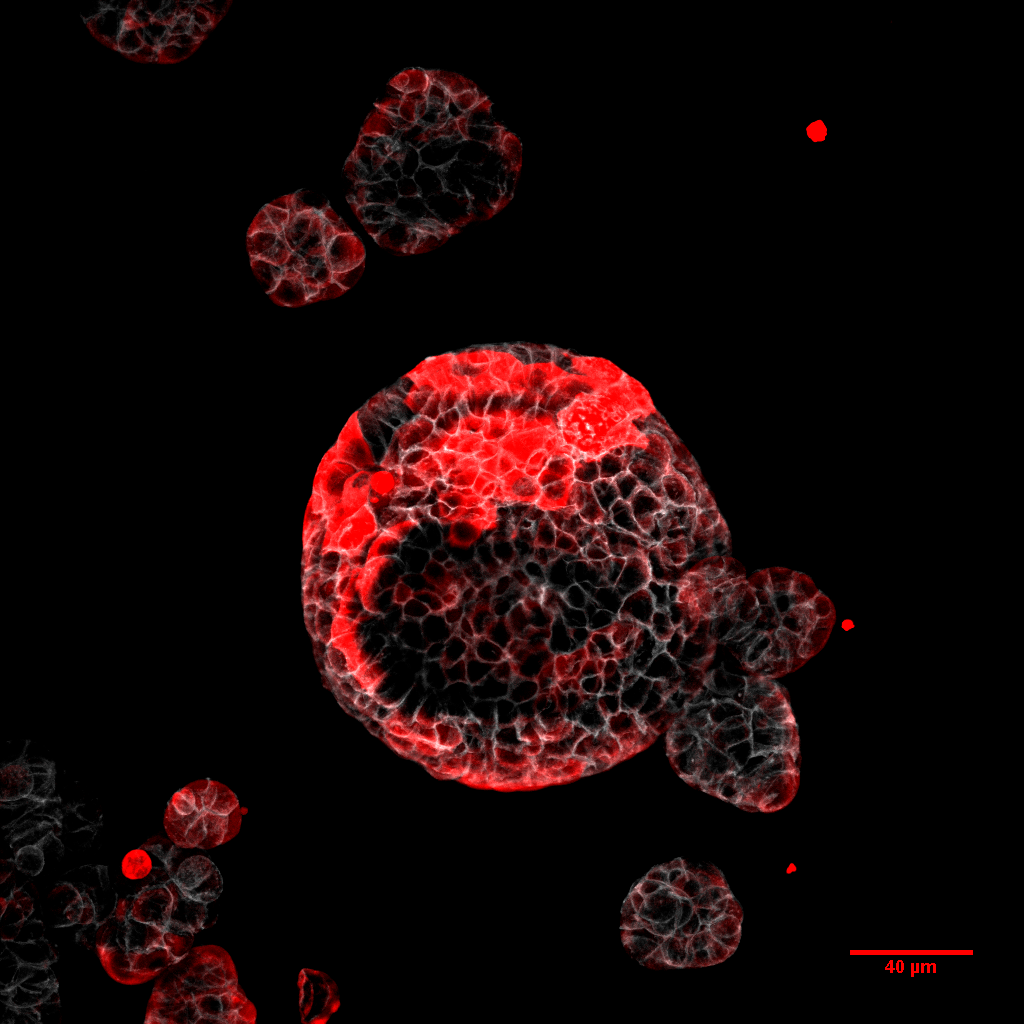 Modelo de cáncer colorrectal con células residuales responsables de la recaída marcadas en rojo.